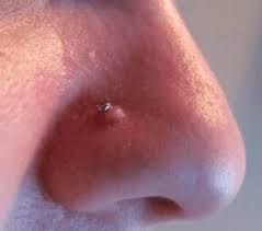 Cómo curar una bolita infectada en el piercing de la nariz